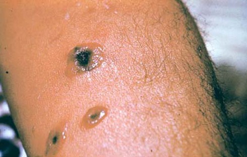 3 người mắc bệnh than do ăn thịt ngựa chết