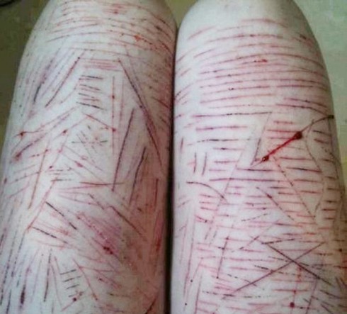 Xôn xao bởi hình ảnh thiếu nữ tự tay rạch đùi