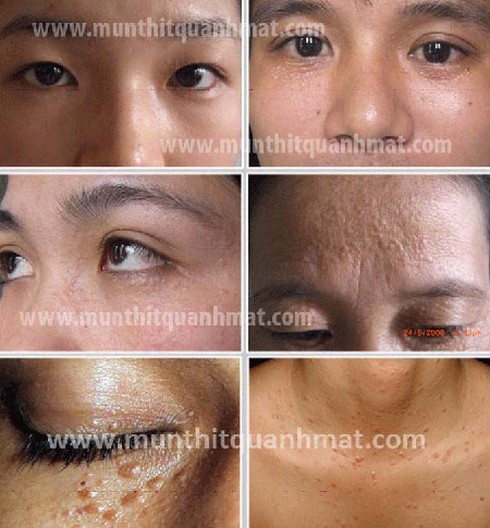 Trị mụn thịt quanh mắt hiệu quả