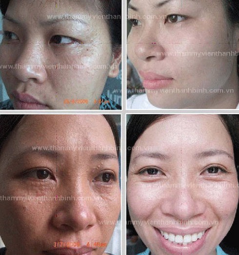 Trị mụn thịt quanh mắt hiệu quả