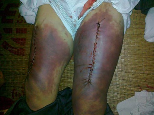 Vụ công an xã đánh chết người: Nạn nhân đã bị tra tấn