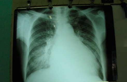 Nghiện rượu, một người Hà Nội có tim to như 'trái bầu'