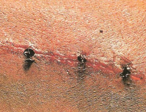 Dùng kiến để khâu vết thương - ảnh 3