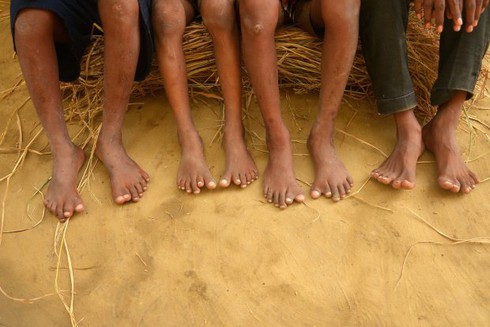 Kỳ lạ gia đình có 25 người có 12 ngón tay, 12 ngón chân - ảnh 2