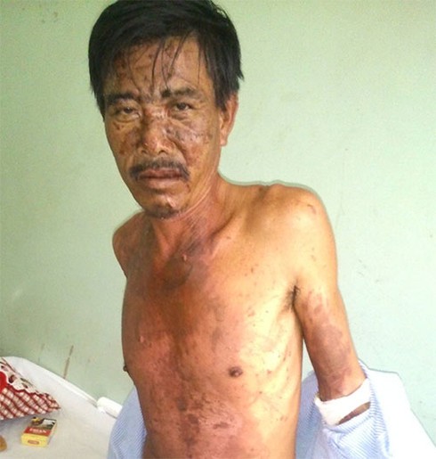 Vợ tạt nồi cháo sôi vào mặt chồng vì bị đánh - ảnh 1