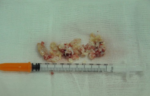 Suýt mất lỗ mũi vì silicon hóa thạch - ảnh 1