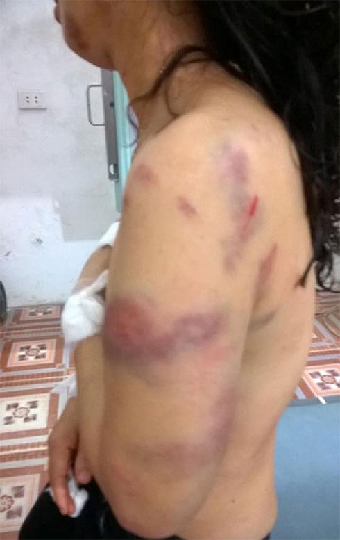 Cô giáo tiểu học bị chồng đánh đập dã man - ảnh 1