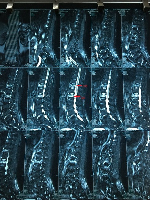 Nằm một chỗ, đứng dậy đi được sau khi bơm... xi măng - ảnh 1