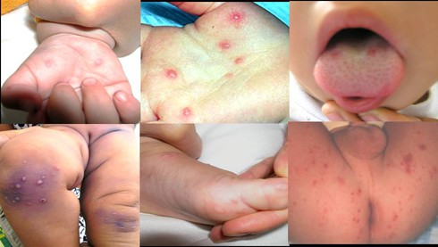 Hà Nội: 73 trẻ mắc tay chân miệng, 2 ca dương tính với virus EV71 - ảnh 1