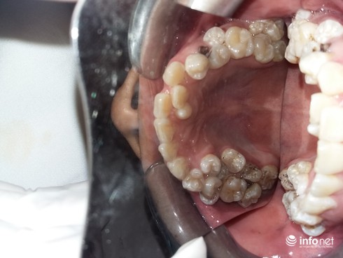 Kỳ lạ chàng trai có tới 45 răng, thừa 13 chiếc - ảnh 1