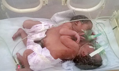 Chiều mai công bố phương án chữa trị cho cặp song sinh dính liền ở Hà Giang - ảnh 1