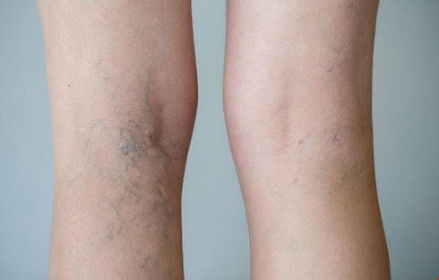Trên 70% người bị suy giãn tĩnh mạch liên quan đến mạch vành - ảnh 1