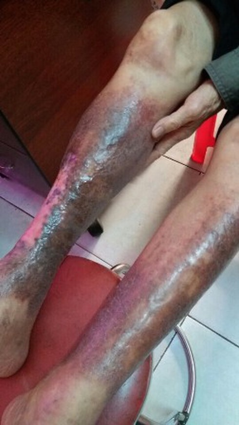 Trên 70% người bị suy giãn tĩnh mạch liên quan đến mạch vành - ảnh 2