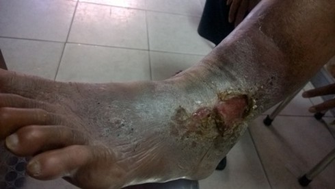 Châm cứu và uống thuốc chữa suy giãn tĩnh mạch chân - ảnh 2