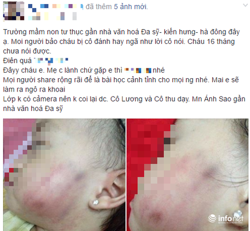 Bé 17 tháng thâm tím mặt khi ở trường mầm non về: Lời trần tình của cô giáo - ảnh 1