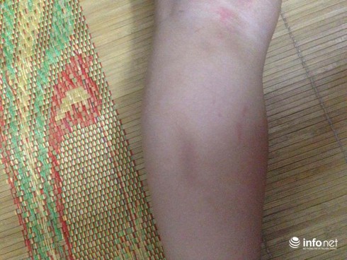 Bé 17 tháng tuổi thâm tím người khi ở trường mầm non về - ảnh 2