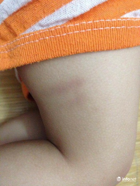 Bé 17 tháng tuổi thâm tím người khi ở trường mầm non về - ảnh 3