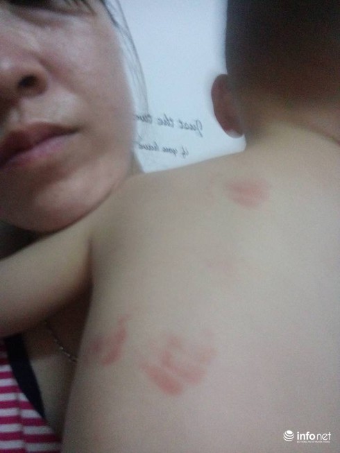 Hà Nội: Bé 20 tháng tuổi bị cắn tím người khi ở trường mầm non về - ảnh 4
