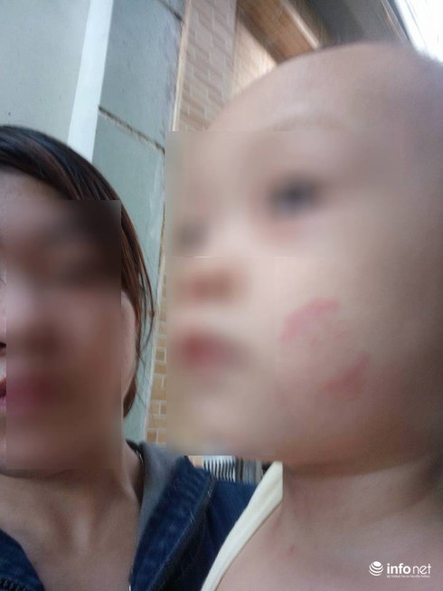 Hà Nội: Bé 20 tháng tuổi bị cắn tím người khi ở trường mầm non về - ảnh 2