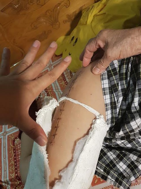 Vụ học sinh gãy xương đùi: Gia đình đã đưa con đi giám định thương tật - ảnh 1