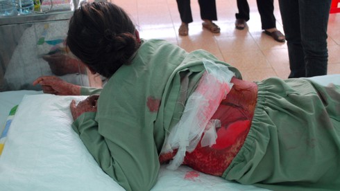 Vụ loét da nghi do thực phẩm chức năng: Nhiễm độc do thuốc - ảnh 1