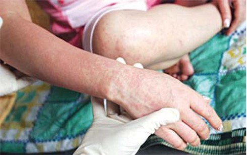Dịch sởi tấn công cả người lớn - ảnh 1