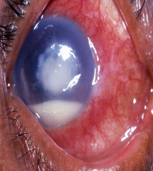 Thiếu nữ mang sẹo trong mắt vì kính áp tròng - ảnh 1