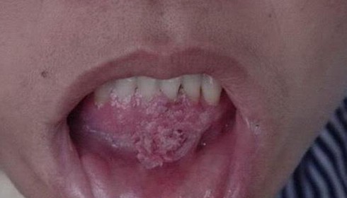 Vợ la khóc khi đốt sùi mào gà, chồng che mặt xấu hổ - ảnh 1