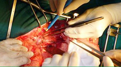 Anh trai chết não, em suy thận không được ghép tạng vì định kiến - ảnh 1