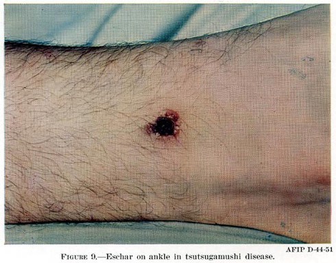 Bệnh sốt mò có lây từ người sang người không? - ảnh 1