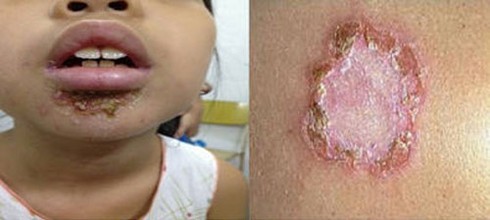 Bé viêm cầu thận vì chốc, bố mẹ tưởng con bị rôm sảy - ảnh 2