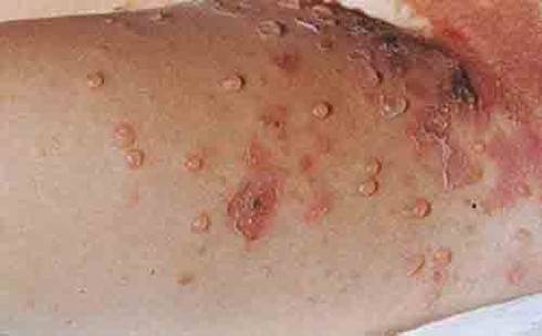 Bé viêm cầu thận vì chốc, bố mẹ tưởng con bị rôm sảy - ảnh 1