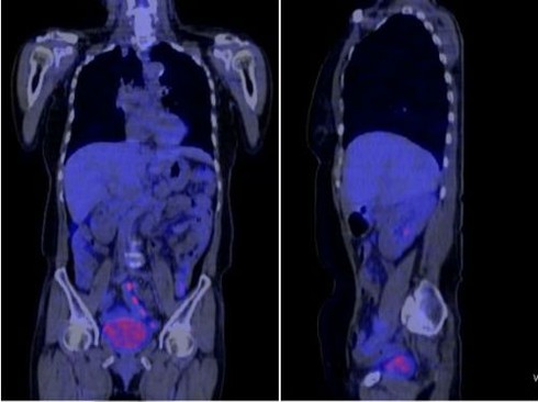 Ung thư di căn, gia đình xin về vẫn điều trị thành công - ảnh 1