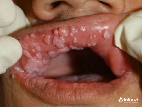 Sùi mào gà mọc chi chít quanh miệng, mùi như thịt thối - ảnh 1