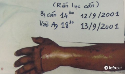 Chặt đứt ngón tay bị rắn cắn, lúc ghép lại vẫn bị liệt cơ - ảnh 1