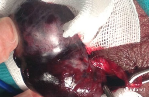 Xoắn tinh hoàn: Chậm một giây, hoại tử cả