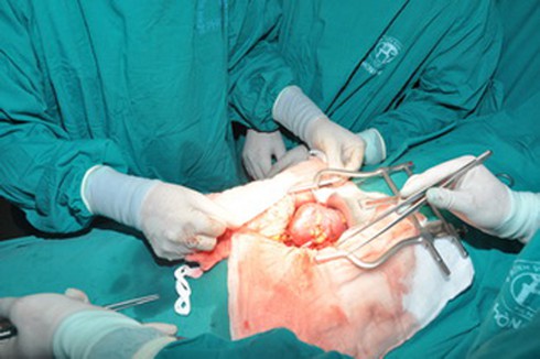 Bệnh viện Xanh Pon giảm chi phí ghép thận, một chàng trai