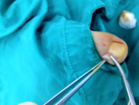 Bệnh oái oăm: Móng chân thâm đen như quả mận - ảnh 2