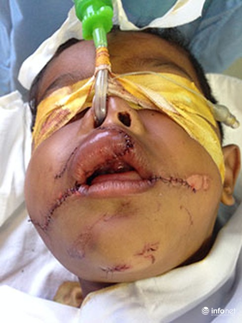 Cháu bé bị biến dạng khuôn mặt vì ngồi trước xe máy - ảnh 1