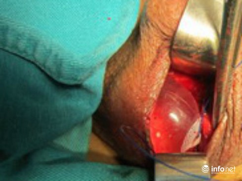 Đặt tinh hoàn nhân tạo sau khi hoại tử - ảnh 1