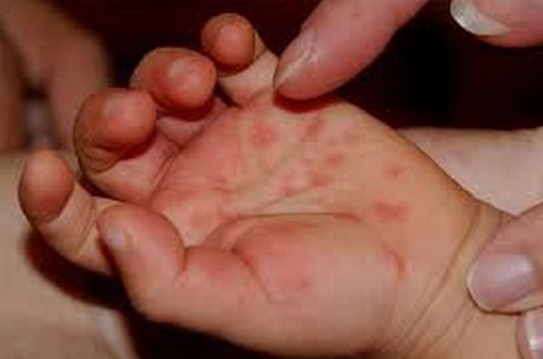 Một trường hợp tử vong vì tay chân miệng - ảnh 1