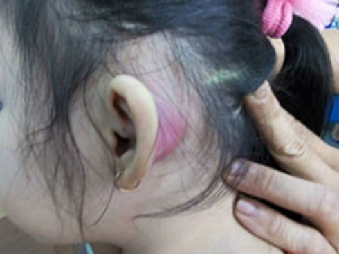 Lỗ nhỏ xíu như đầu kim ở vành tai trẻ là bệnh gì ? - ảnh 1