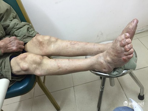 Suy thận vì điều trị gout ở phòng khám đông y Trung Quốc - ảnh 1