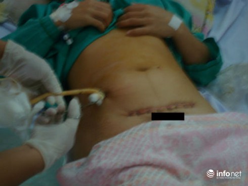 Những sản phụ có nguy cơ vỡ tử cung - ảnh 1