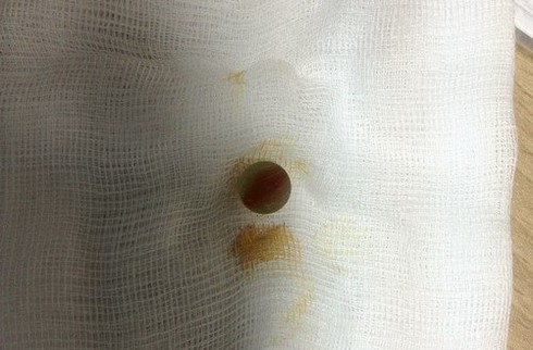 Bác sĩ phát khiếp khi bệnh nhân nhét 6 viên bi sắt vào của quý - ảnh 1