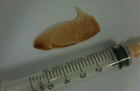 Bệnh nhân 82 tuổi hóc xương cá dài 5 cm - ảnh 1