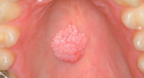 Chồng đi tiếp khách mang sùi mào gà về