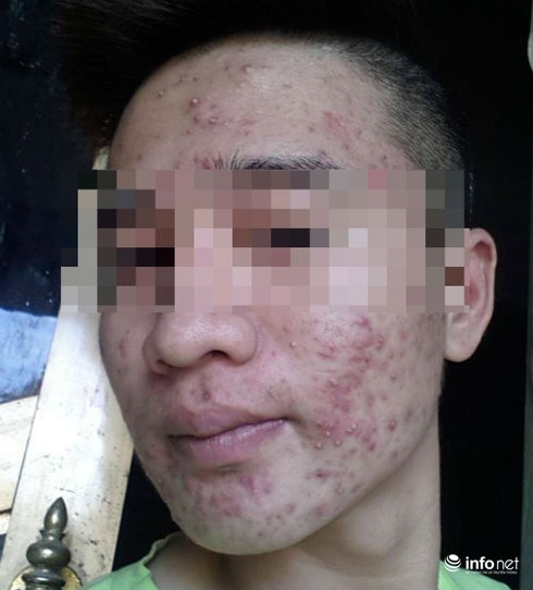 Dùng kem trắng da siêu tốc mua trên mạng, rước mụn chi chít - ảnh 1