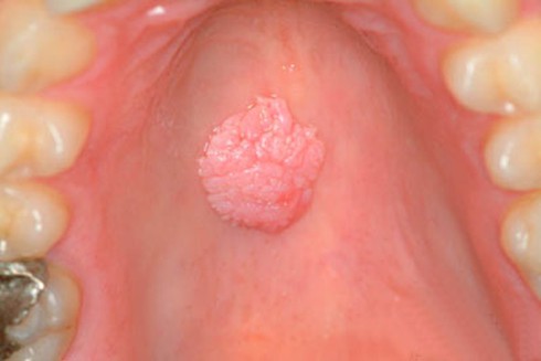 Dùng chung bàn chải đánh răng, nữ sinh mắc sùi mào gà - ảnh 1