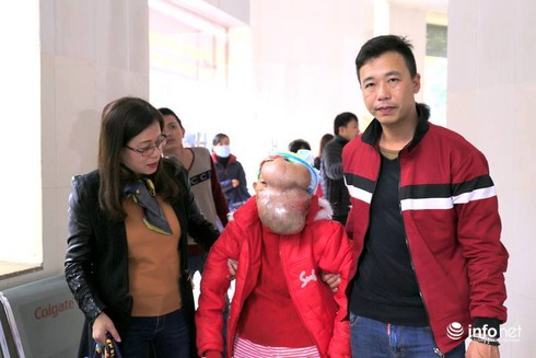 Thêm một phụ nữ có khối u khổng lồ trên mặt chuẩn bị mổ - ảnh 1